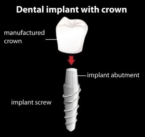 Dental implant breakdown