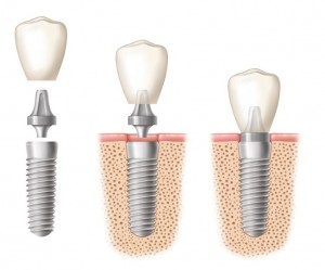 how dental implant is placed