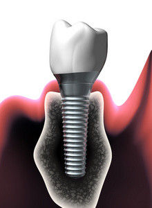 Dental implants and your diet