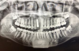 dental implant X-ray