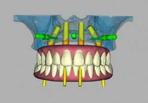 3d image of a denture